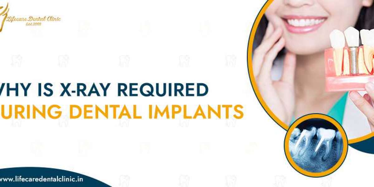 Why Is X-Ray Required During Dental Implants